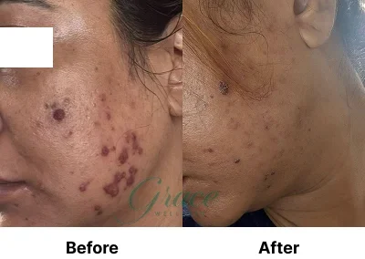 Before-After | The Grace Wellness
