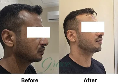 Before-After | The Grace Wellness