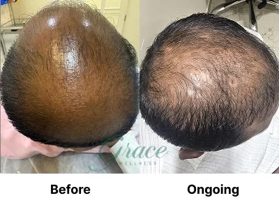 Before-After | The Grace Wellness