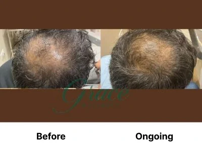 Before-After | The Grace Wellness