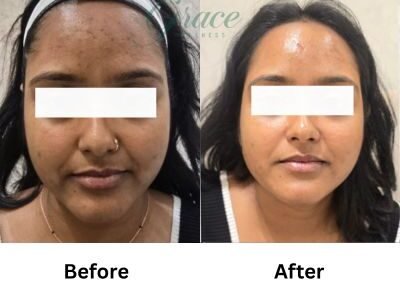 Before-After | The Grace Wellness